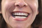 Umreißende und umgestaltende Zähne
